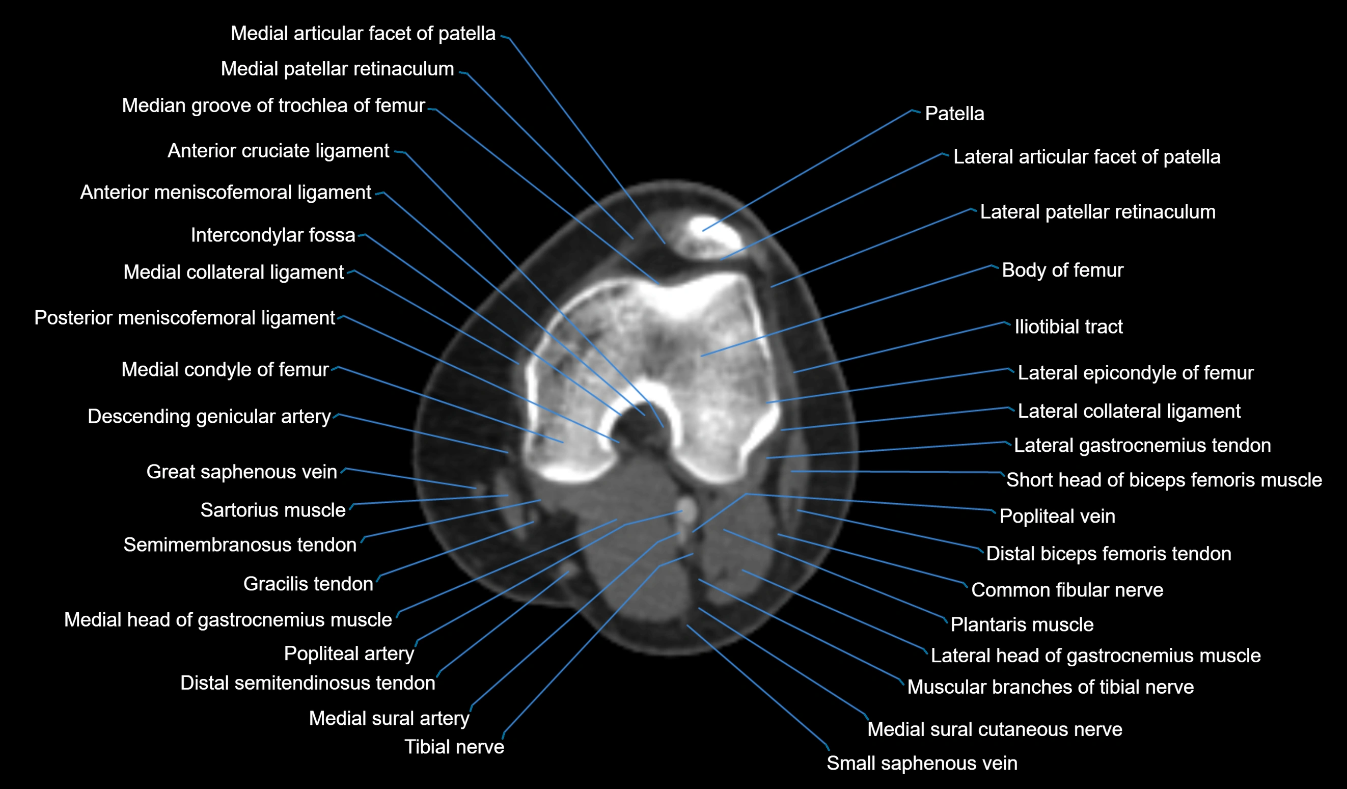CT knee axial cross sectional anatomy labelled image-00029.webp